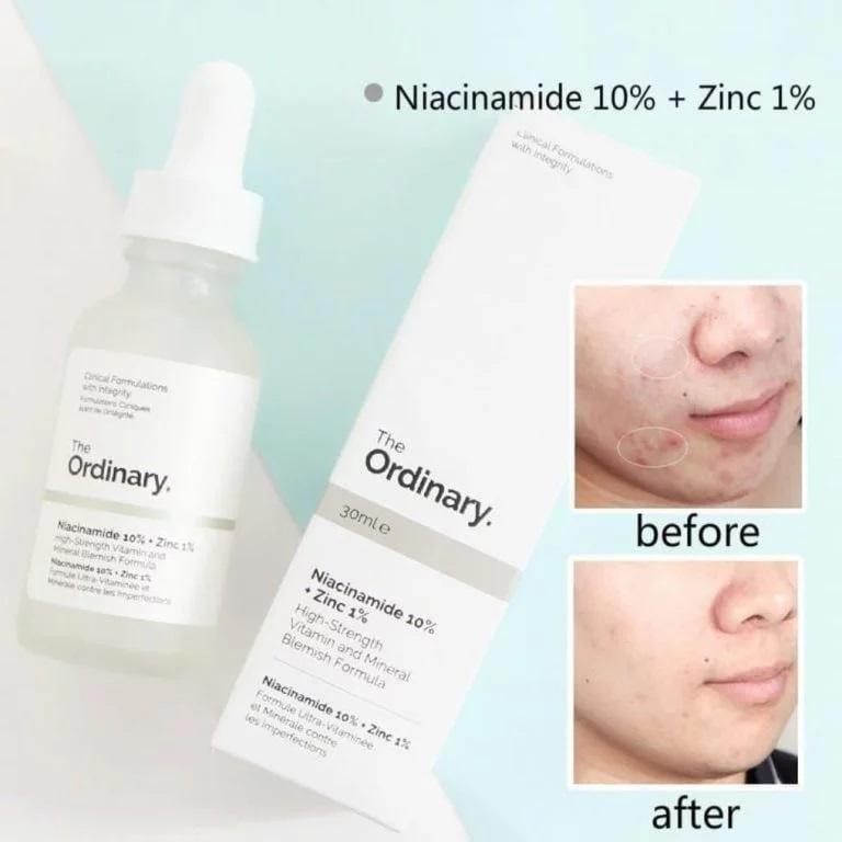 30ml Niacinamide Serum - Anti-Acne & Hydrating Treatment, 1 Pcs for Even Skin Tone